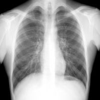 Рентгенография грудной клетки — что это?