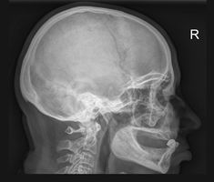 Рентген височной кости: показания