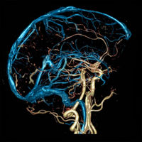 МРТ сосудов головного мозга - что показывает