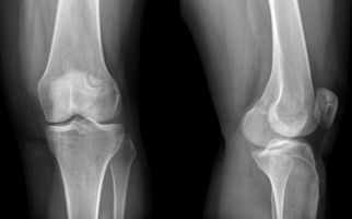 Рентген коленного сустава - подробное описание снимка