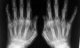 Как выглядит рентген пальцев руки